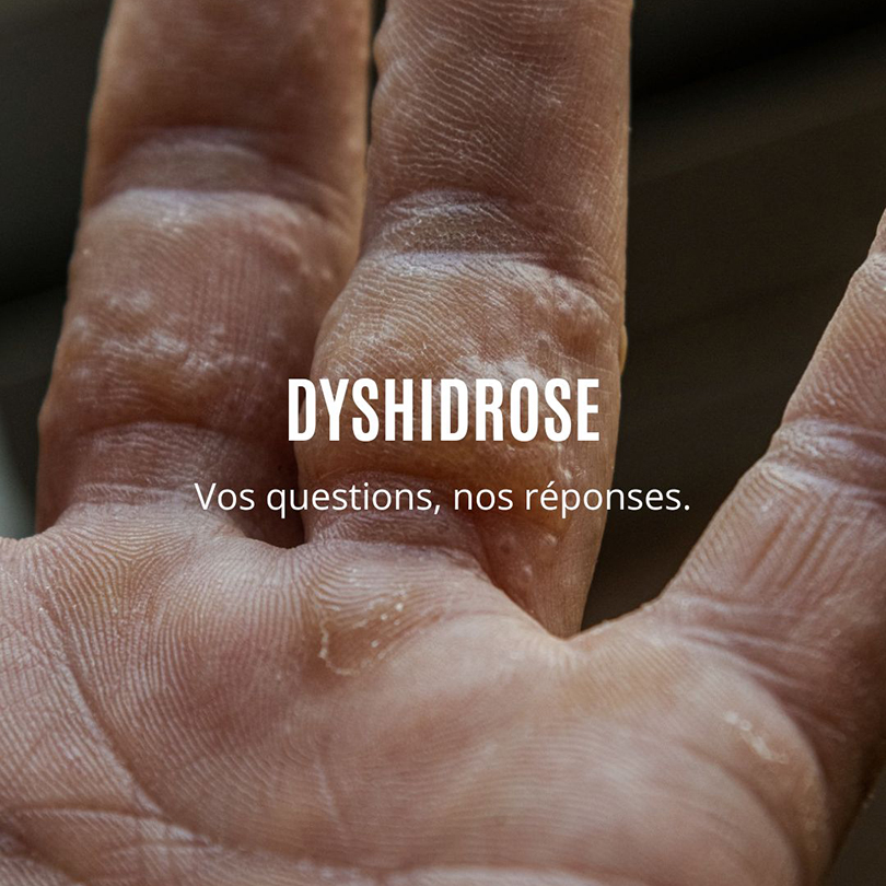 Instagram-dyshidrose